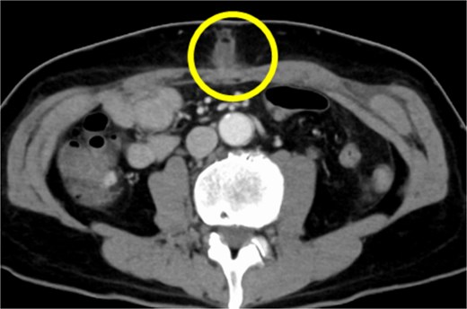 CT findings suggestive of an SSI. The circles indicate abscesses.