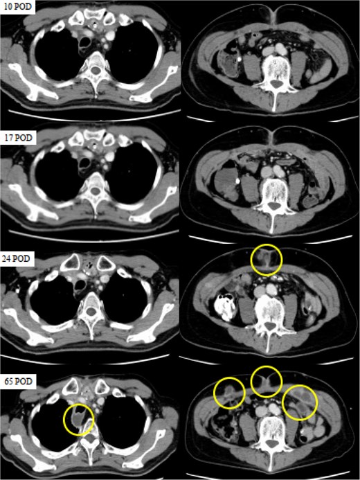 CT images obtained on postoperative days (POD) 10, 17, 24, and 65. The circles indicate abscesses. CT scans were performed on POD 10 and 17 to investigate the high levels of inflammation, but no abnormalities were detected. While no apparent abnormalities were observed on POD 10 and 17, SSI was evident on POD 24, and multiple abscesses had formed in the posterior trachea and abdominal wall by POD 65.