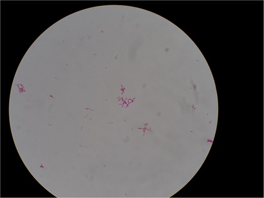 Acid-fast bacilli identified by Ziehl–Neelsen staining of liquid culture. Magnification, ×1000.