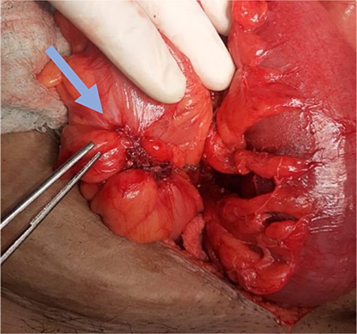 Sigmoid colon tumor (arrow).
