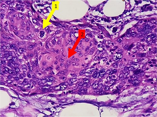 (H&E 400×) Showing malignant squamous cells with increased N:C ratio, nuclear pleomorphism, vesicular to hyperchromatic nuclei, and occasional nucleoli. Evidence of mitotic figures (arrow marked 1) and keratinization (arrow marked 2).