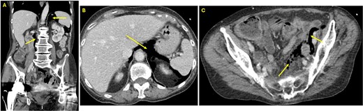 (A) Coronal view CT of the abdomen and pelvis showing free air in the retroperitoneum (arrows). (B) Axial view CT of the abdomen and pelvis at the level of the liver demonstrating free air in the retroperitoneum (arrow). (C) Axial view CT in the pelvis revealing free air in the colonic mesentery (arrows), consistent with extraluminal gas from rectal perforation.