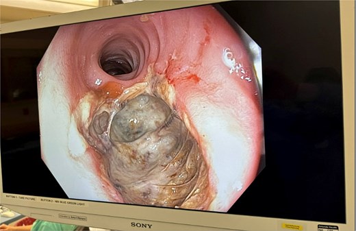 Initial findings on exam under anesthesia with flexible sigmoidoscopy revealing right lateral rectal wall disruption 8 cm from the anal verge, involving ~30% of the luminal circumference.