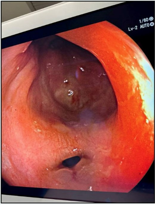 Follow-up flexible sigmoidoscopy at 4 weeks showing near-complete healing of the rectal perforation, with a small residual mucosal disruption.