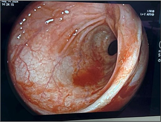 Flexible sigmoidoscopy at 6 weeks demonstrating complete mucosal healing and re-epithelialization at the prior perforation site, with no residual defect or inflammation.
