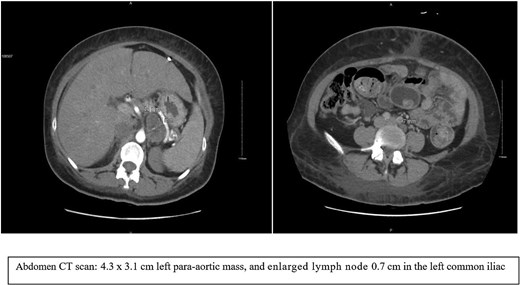 CT abdomen images showed left para-aortic mass.