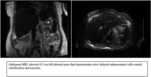 MRI images showed a well-defined left para-aortic mass that mostly arises from the left adrenal gland.