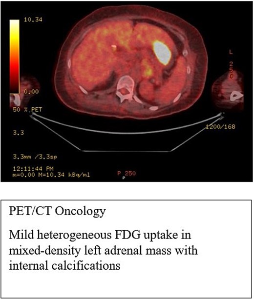 PET-CT scan showed heterogeneous FDG uptake in a mixed-density left adrenal mass with internal calcifications.