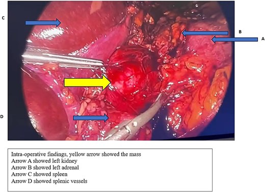 Intraoperative findings of retroperitoneal mass resection.