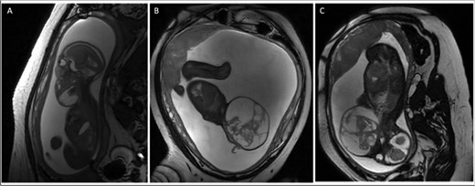 (A) Sagittal T2 weighted fetal MRI at 21 weeks gestation with fetal mass volume of 33 ml (3.7 × 4.7 × 3.6 cm). (B) Sagittal T2 weighted fetal MRI at 29 weeks gestation with fetal mass volume of 411 ml (10.3 × 9.3 × 8.2 cm). (C) Coronal T2 weighted fetal MRI at 29 weeks demonstrating fetal neck hyperextension due to mass effect.