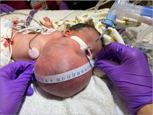 Image of newborn with large cervical mass measuring 17 × 19 cm.