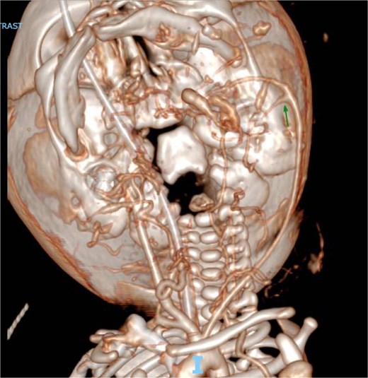 CT angiogram of the head with intravenous contrast demonstrating a hypervascular mass with arterial feeders originating from the left thyrocervical trunk, left external carotid artery, and right external carotid artery.