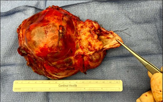 Image of resected teratoma.