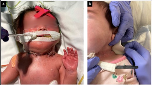 (A) Image of the cervical incision on post-op Day 6. (B) Image of patient’s incision at a 5-month follow-up visit.