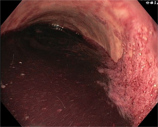 Demonstrates the gastroscopy findings, showing the stomach filled with blood.