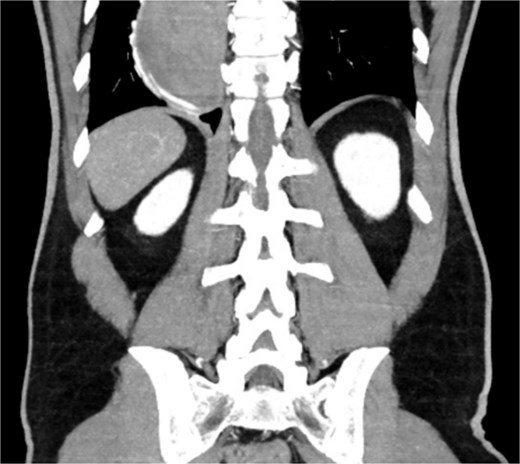 CT scan showing a markedly dilated esophagus with contrast blush in the distal third.