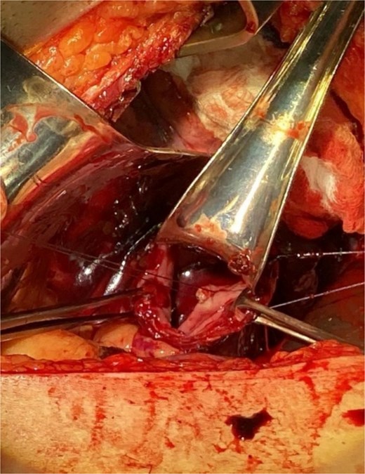 Illustrates the oversewing of the bleeding vessel to achieve hemostasis.
