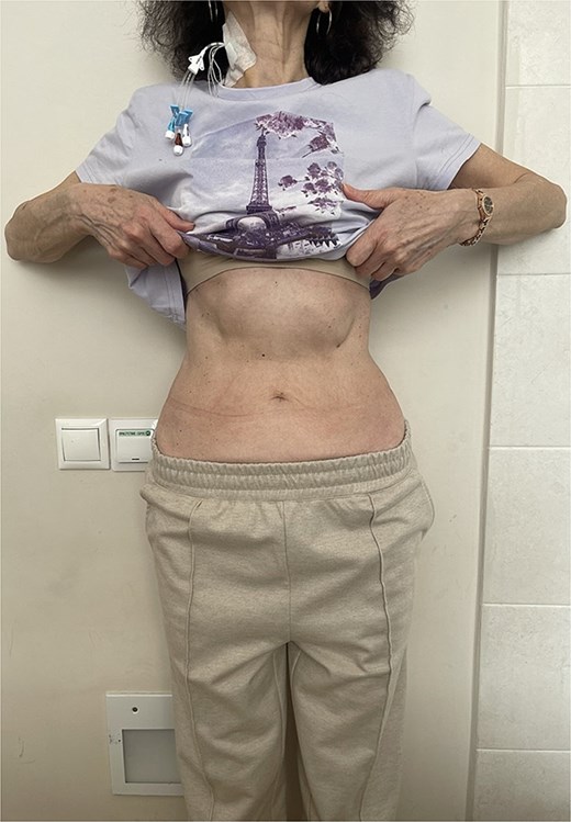 Clinical photograph of the patient’s abdomen at admission.