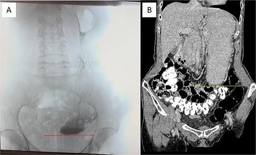 Pre-operative imaging confirming GOO. (A) X-ray of the stomach and duodenum with contrast medium. Line indicates the lower border of the stomach. (B) CT scan of the abdomen with intravenous contrast. Line demarcates the lower border of the stomach.