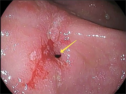 Pre-operative esophagogastroduodenoscopy (EGD) view. An arrow indicates the pylorostenosis.