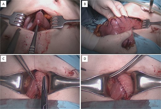 Intraoperative procedure of laparoscopically assisted distal gastrectomy with Billroth I anastomosis. (A and B) Extraction and transection of the distal stomach through a mini-laparotomy access wound. (C and D) Creation of a hand-sewn, double-layered gastroduodenal (Billroth I) anastomosis.
