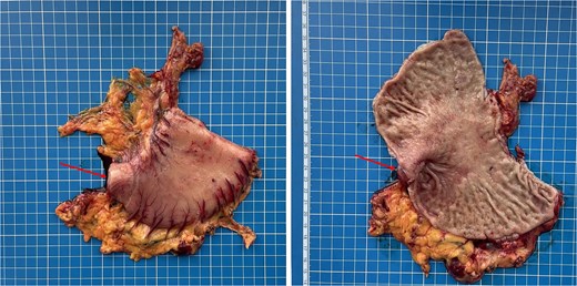 Gross specimen of the resected distal stomach. The arrows indicate the area of severe fibrotic stenosis in the pyloroduodenal region.