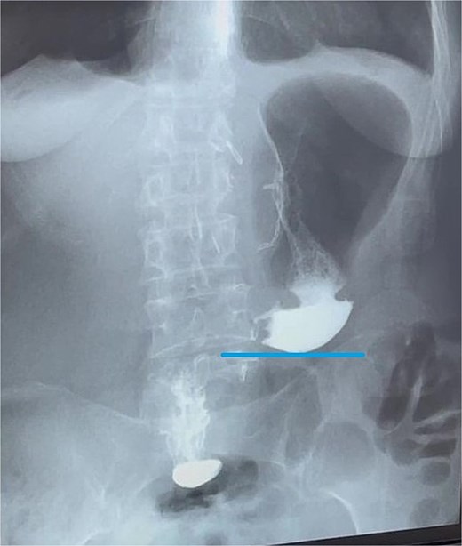 Contrast X-ray study performed on the third postoperative day. The image demonstrates free passage of contrast through a widely patent gastroduodenal (Billroth I) anastomosis without evidence of leakage or obstruction. Line indicates the newly configured lower border of the gastric remnant.