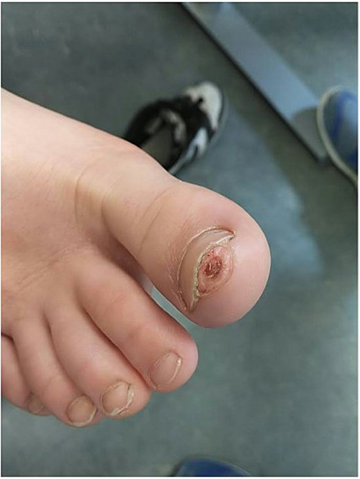 Clinical photograph of case 1 showing the subungual exostosis lesion prior to surgical treatment.