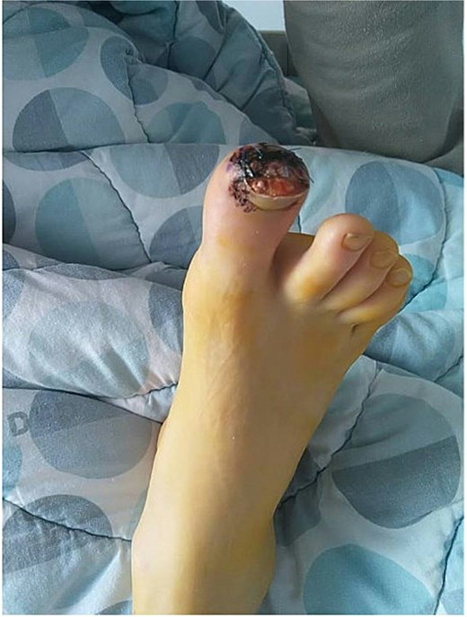 Postoperative image of the affected toe in case 1, following surgical excision and debridement.