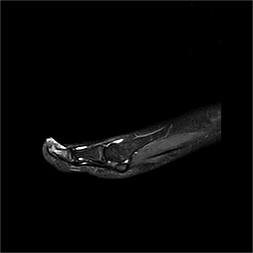 Preoperative MRI from case 1 demonstrating SE and associated bone marrow edema.