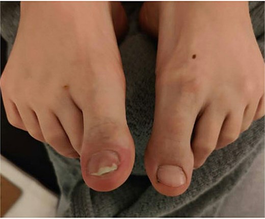 Clinical photograph of case 2 showing the SE lesion prior to surgical treatment.