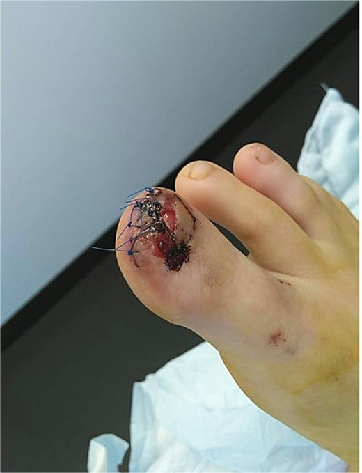 Postoperative image of the affected toe in case 2, following SE and debridement.