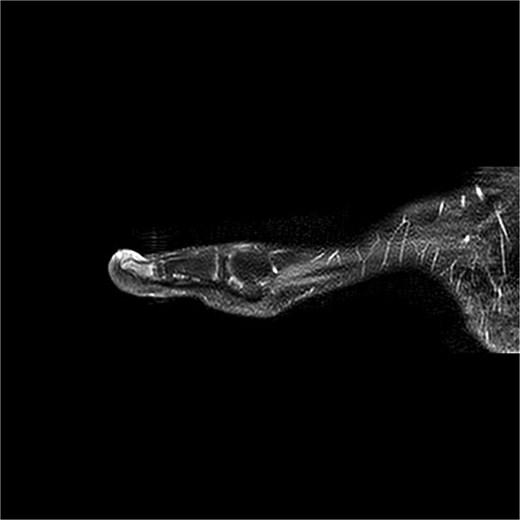 Preoperative MRI from case 2 demonstrating SE and associated bone marrow edema.