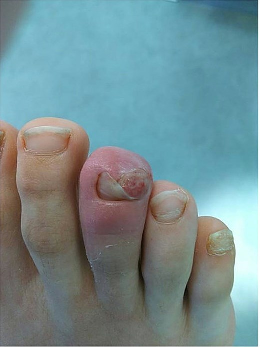 Clinical photograph of case 3 showing the SE lesion prior to surgical treatment.