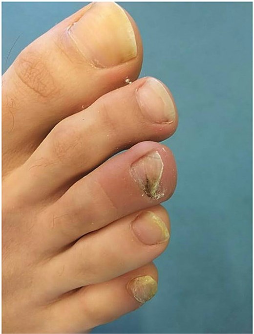 3 weeks postoperative image of the affected toe in case 3, following SE and debridement.
