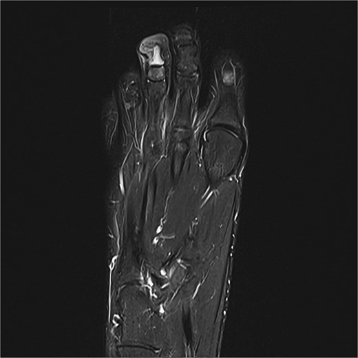 Preoperative MRI from case 3 demonstrating SE and associated bone marrow edema.