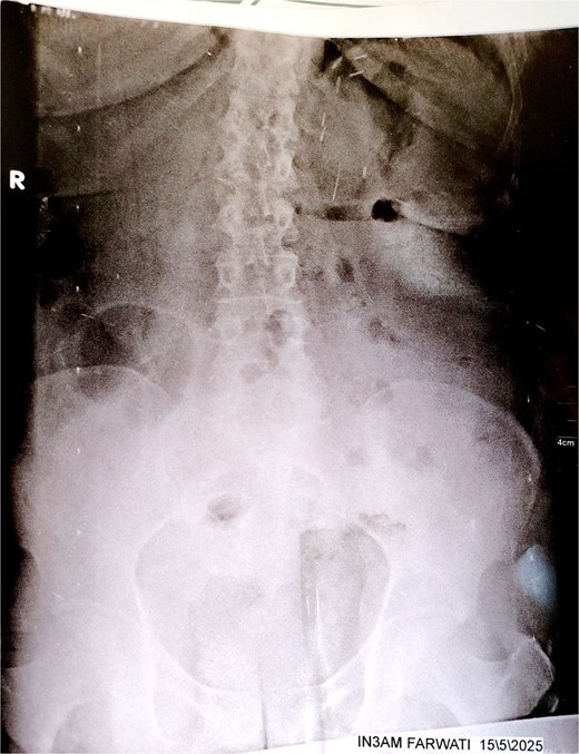 Plain abdominal X-ray (upright position) showing prominent colonic and small bowel gas patterns with no visible air-fluid levels or signs of acute obstruction. No abnormal bowel positioning or dilation is clearly evident. These findings were non-specific and contributed to the diagnostic delay.