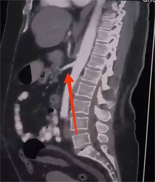 Sagittal CT scan showing a retromesenteric course of the duodenum (indicated by an arrow).