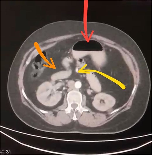Axial contrast-enhanced CT scan demonstrating abnormal positioning of abdominal structures: The stomach is seen in the upper center (arrow), the duodenum crosses the midline anteriorly (arrow), and the superior mesenteric artery lies abnormally to the right of the superior mesenteric vein (arrow).