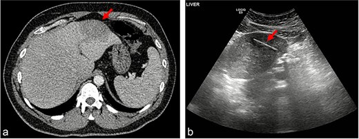 (a) Hypoattenuating lesion in the left lobe of the liver; (b) linear hypoechoic structure within a hypoechoic lesion.
