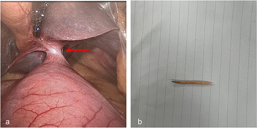 (a) Fistulous communication between liver Segment 3 and lesser curvature of stomach; (b) retrieved cocktail stick.