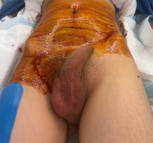 Photograph of patient’s groin post-induction showing swelling in the left inguinal region and empty left hemiscrotum.