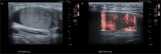 Ultrasound images of the left and right testis. The left testis located in inguinal canal with no visible Doppler flow and heterogeneous internal echoes suggestive of impaired vascularity.