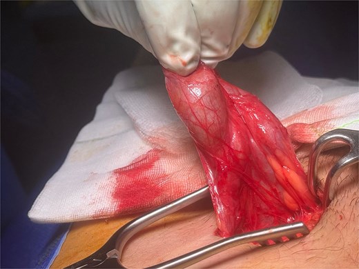 Surgical exposure of inguinal canal showing tethered testis encased in dense fibrous tissue.