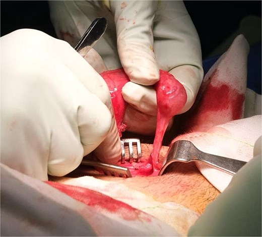 Operative image of the left testis after adhesiolysis, highlighting an elongated gubernaculum.