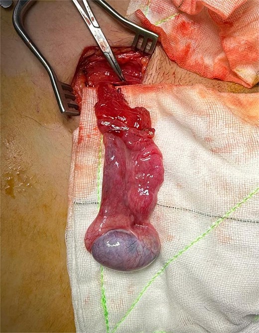Freed testis appearing well perfused and capable of being delivered to scrotum.