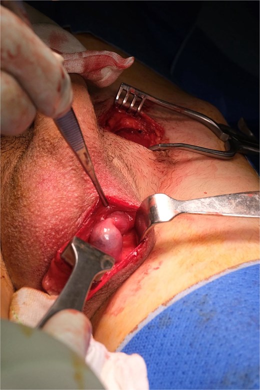 Open scrotal pouch ready for orchidopexy after tunnel formation beneath dartos.