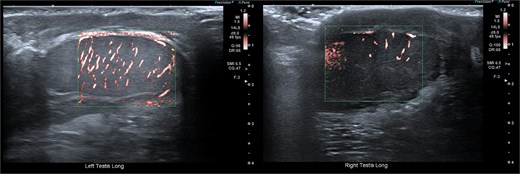 Ultrasound image of left testis in scrotal position showing uniform echotexture and normal colour Doppler flow, consistent with preserved viability post-orchidopexy.