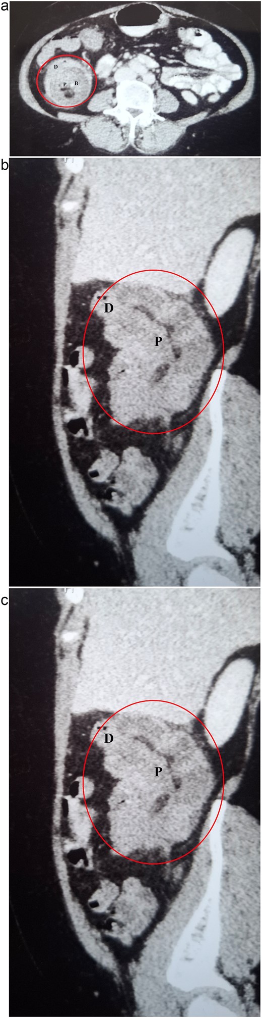 CECT abdomen demonstrating colocolic intussusception involving the ascending colon (encircled in red). (a) Axial view showing the characteristic multilayered appearance, with the proximal bowel (P) containing mesenteric blood vessels (B) and fat, surrounded by the thick-walled distal bowel (D). (b) Coronal view. (c) Sagittal view.