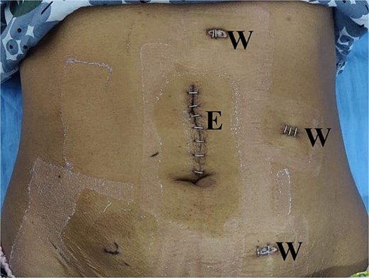 Laparoscopic port placement. E: Extraction port; W: Working port.